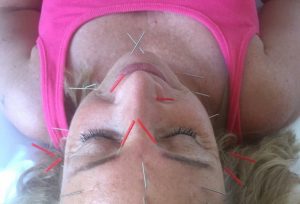 Is acupuncture the new Botox?